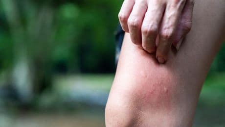 Juckreiz-Alarm - Was wirklich gegen Mückenstiche hilft