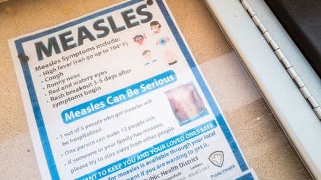 Measles math: What to know about 1,001 measles cases across the country