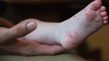 Doctors see surge in hand, foot and mouth cases this summer