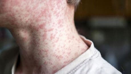 Crisis in Spain as tourist hotspots hit with infectious disease outbreak