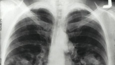 Tumore al polmone, al via la prima terapia a bersaglio molecolare: la forma rara colpisce anche giovani e non fumatori
