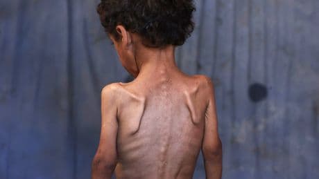 Wer sieht hin? Das macht der menschengemachte Hunger mit den Kindern in Gaza