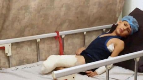 Hohe Zahl an Amputationen: Kinder in Gaza: "Als ich nachschaute, war mein Bein weg"