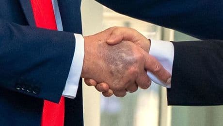 Bluterguss: Trumps Hand sorgt erneut für Aufsehen