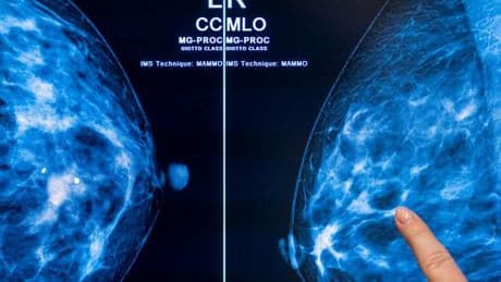 Programm zur Früherkennung: Mammografie-Screening senkt Brustkrebs-Sterblichkeit
