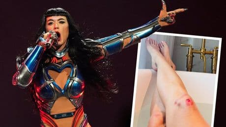 Gute-Besserungs-Küsschen von Trudeau? - Katy Perry zeigt Tour-Blessur