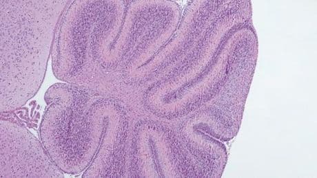Un enfant remarche grâce à un nouveau traitement pour pallier la déficience en coenzyme Q₁₀