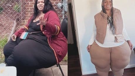 'I weighed 51-stone due to common misdiagnosed condition now I'm 25-stone lighter'