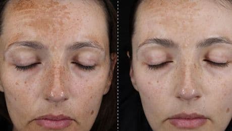 Results from this new pigmentation serum are incredible – skin is transformed in weeks