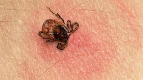 Kene Nedir, Nasıl Anlaşılır? Kene Isırığı Tedavisi Nasıl Yapılır?