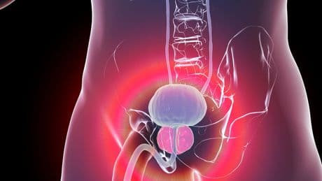 Genauer als PSA-Wert: Wie ein einfacher Urintest Prostatakrebs erkennt