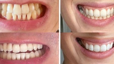 'Biggest ever' teeth whitening sale beats Amazon Prime Day with 50% off