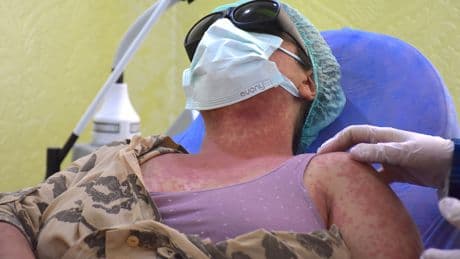 Sürdükleri krem hayatlarını kararttı: 4 kişi hastanelik oldu