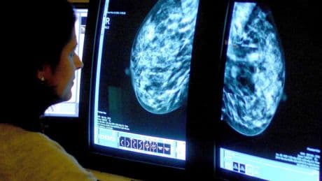 How the rising cost of breast cancer may mean women go undiagnosed