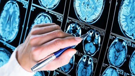 Les États-Unis approuvent le premier test sanguin de dépistage d'Alzheimer