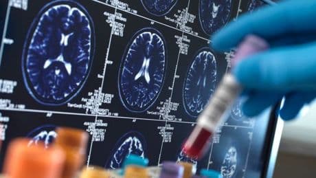 Morning tea or coffee could slash risk of Alzheimer’s disease