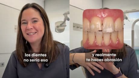 Almudena Herraiz, ortodoncista: “Usar pasta blanqueante durante mucho tiempo y cepillarse fuerte puede generar abrasión en los dientes”