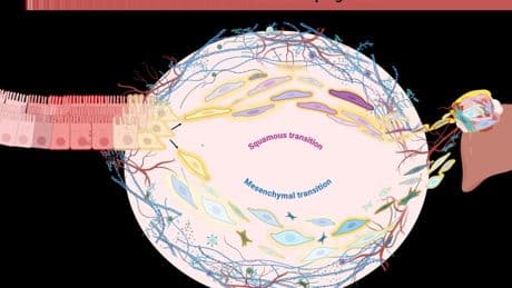 Bowel cancer cells can ‘shapeshift’ to enable aggressive spread, research finds