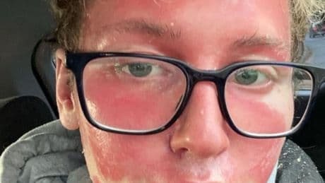 Fillers triggered painful skin condition that left teenager looking ‘like an alien’