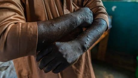 "Une urgence de santé publique": l'OMS maintient son alerte pour le mpox et appelle à "un soutien international continu"