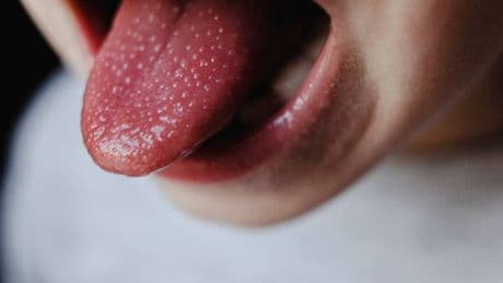 UKHSA warns over Scarlet Fever symptoms and urges people to call GP first