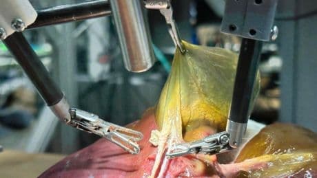 Robot cerrah sıfır hata ile ameliyat yaptı, tüm kararları kendi aldı