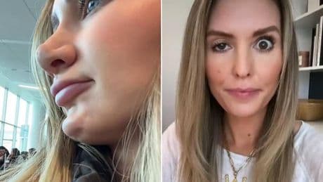 Doctors raise alarm over 'DIY Botox' trend that could leave you deformed