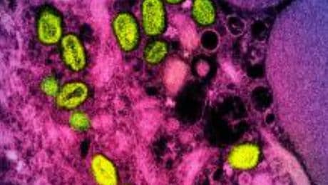 Urteil im Prozess um Mpox-Erkrankung: Drei Wochen Zwangs-Quarantäne waren zu lang