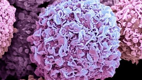 Three-drug treatment combo ‘holds back aggressive breast cancer for a year’