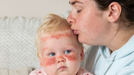 'My baby got sunburnt in three hours, in Scotland - I won't make same mistake'