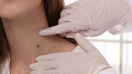 4 yıl umursamadı, kanser çıktı! İlk işareti nokta gibi: 'Kolumun bir kısmı alındı'