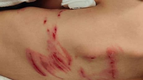 Nagel-, bijt- en schaafwonden bij 6-jarig jongetje na incident met vermoedelijk wolf