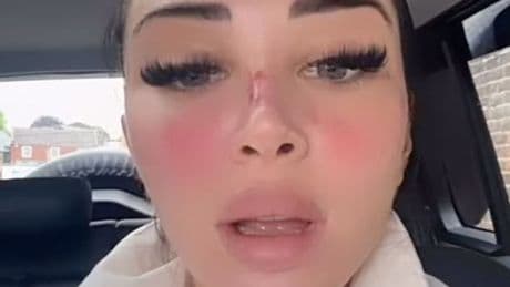 Tulisa reveals painful bloodied nose after undergoing six beauty treatments