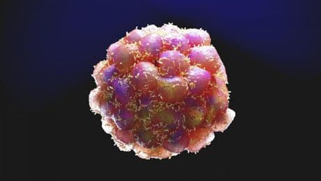Hallada una proteína que inicia las metástasis del cáncer de mama y que se puede inhibir con fármacos