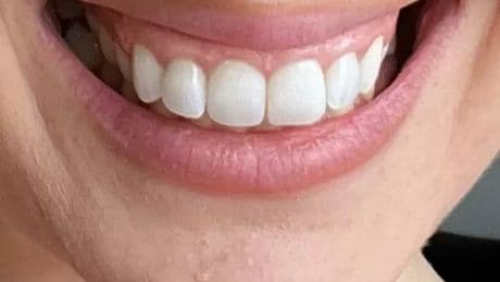 Teeth whitening solution 'removes stains' quickly in time for summer holidays