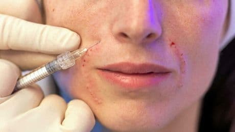 « C’est comme se faire une manucure » : comment le Botox s’est banalisé