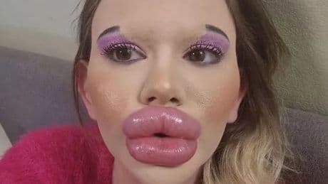 Woman with 'world's biggest lips' looks unrecognisable before extreme filler