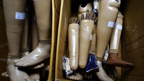 Royaume-Uni : un chirurgien s’auto-ampute les jambes pour escroquer les assurances