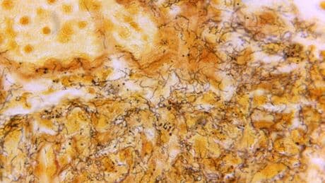 Montreal public health reports sharp increase in tuberculosis, syphilis cases