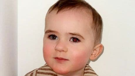 Toddler diagnosed with cancer after his parents noticed a white glow in his eye