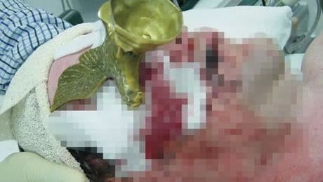 Man impales eye after falling face-first onto eagle figurine – narrowly missing his brain