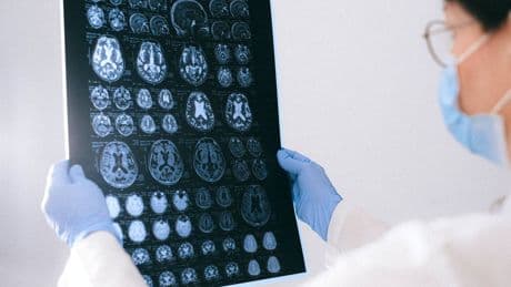 Alzheimer e Parkinson, trovate le spie: la scoperta che cambia tutto