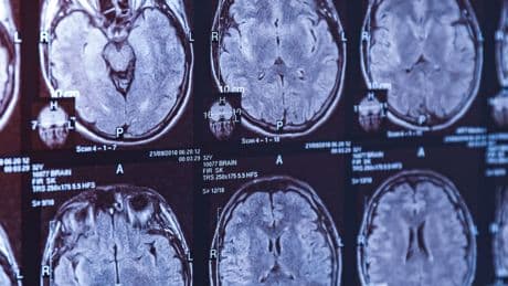 Alzheimer tanısında çığır açan gelişme