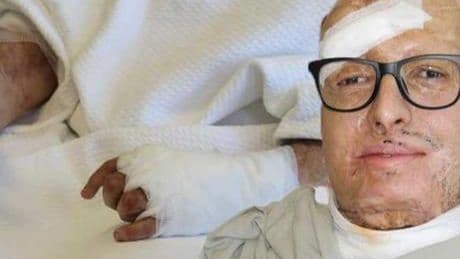 6 bin voltluk akıma kapıldı! Ölümden dönen genç mühendis Türkiye'de şifa buldu