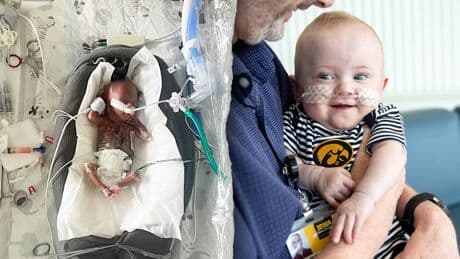 World's most premature baby defies all medical odds to reach 1st birthday