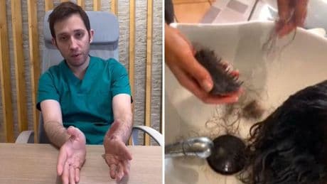Un dermatólogo capilar, tajante con la moda de las trenzas en verano: "No son seguras, pueden provocar alopecia"