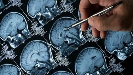 Alzheimer e Parkinson, scoperte le spie molecolari. «Permettono diagnosi precoci». Lo studio record su 35mila campioni