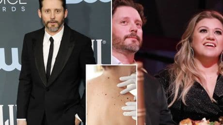 What to know about dangerous ‘black tumor’ cancer as Kelly Clarkson’s ex-husband Brandon Blackstock dies at 48