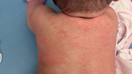 B.C. premier pins measles surge on anti-vaccine ‘recklessness’
