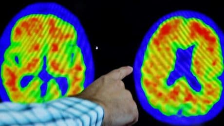 Uçuk ve Alzheimer arasında bağlantı keşfedildi